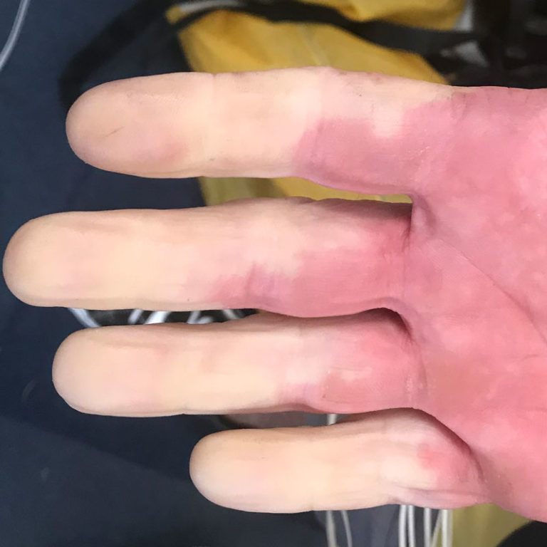 Taking vibration syndrome in hand Inside Government NZ